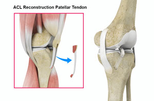 ACL Reconstruction Patellar Tendon