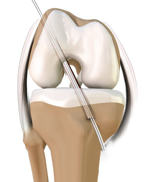 Arthroscopic ACL Reconstruction