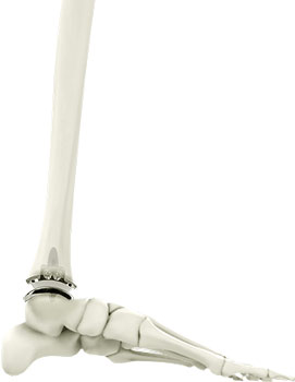 Ankle Joint Replacement