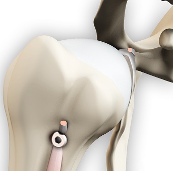 Arthroscopic Tenotomy and Tenodesis