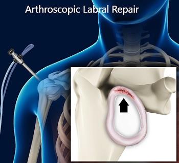 Arthroscopic Labral Repair