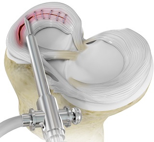 Arthroscopic Meniscus Repair & Meniscectomy