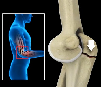 Olecranon Fractures Mission