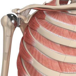 Total Shoulder Replacement